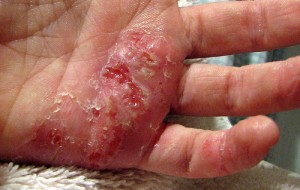 benh-eczema