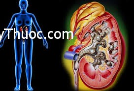 benh-viem-cau-than-man-tinh-benhvn1