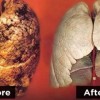 ung thư phổi