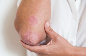 mot-benh-nhan-bi-vay-nen-anh-minh-hoa