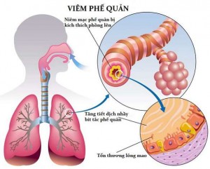 viem-phe-quan-man-tinh