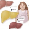 graphic-fatty-liver-4720-1510281872