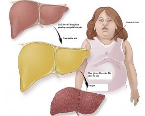 graphic-fatty-liver-4720-1510281872