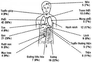 ung-thu-amidan