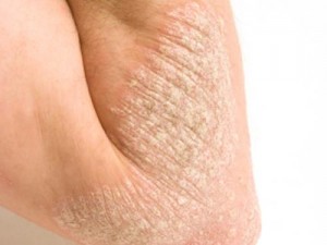 benh-vay-nen-va-cach-dieu-tri1_251132993