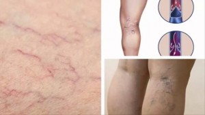 gian-tinh-mach-chan-va-nhung-dieu-can-luu-y_211648328