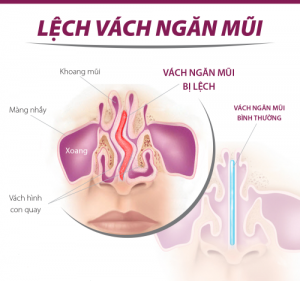 lech-vach-ngan-mui_23152599