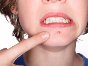 ung-thu-da-va-mun-nhot-phan-biet-nhu-the-nao