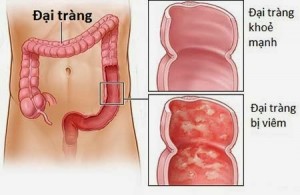 benh-viem-dai-trang-co-nguy-hiem-khong-148
