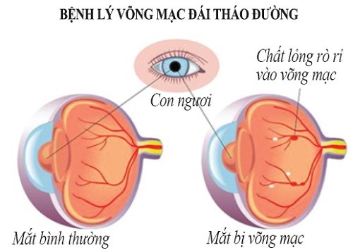 cac-benh-ve-mat-thuong-gap-o-nguoi-benh-dai-1.png