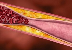 benh-mo-mau-e1498190431122