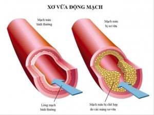 chia-khoa-nao-cuu-song-nguoi-benh-xo-vua-dong-mach_61122277