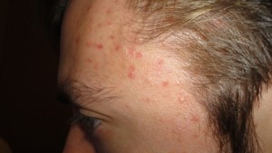 vi-tri-moc-mun-tren-guong-mat-dang-canh-bao-tinh-trang-suc-khoe-e8d4a6