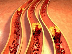 bai-thuoc-hay-giam-cholesterol-trong-vong-1-thang