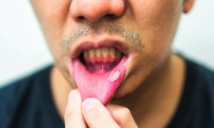 Phat-hien-thu-pham-moi-gay-ung-thu-mieng-1-1550327216-395-width665height399